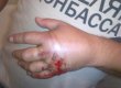 Міліція заявила, що "прострелену" руку людини в скандальній футболці було поранено перфоратором