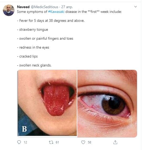 Симптомы болезни Кавасаки. @MedicSeditious

