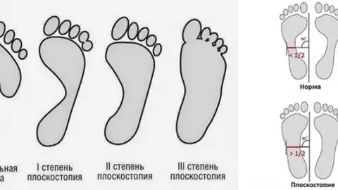 Плоскостопие. 