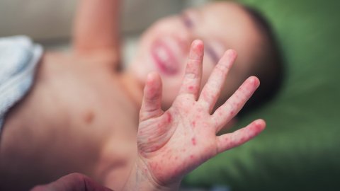 В Запорожье принимают меры по недопущению дальнейшего распространения кори. Фото: avopix.com