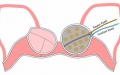 Wearable device for local hyperthermia. Picture: TechnicalTextile.net.