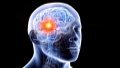 Brain cancer. Photo by Xinhua.