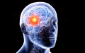 Brain cancer. Photo by Xinhua.
