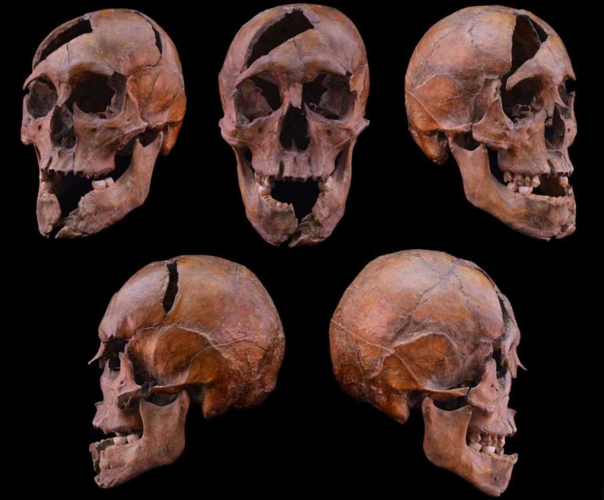 Череп Бели Ростиславовича з ушкодженнями з різних боків. Hajdu et al. / Forensic Science International: Genetics, 2025